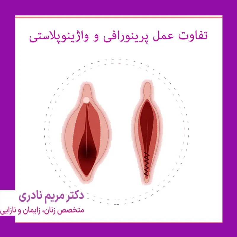 تفاوت-عمل-پرینورافی-و-اژینوپلاستی