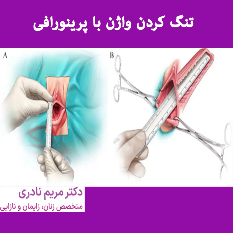 تنگ-کردن-واژن-با-پرینورافی