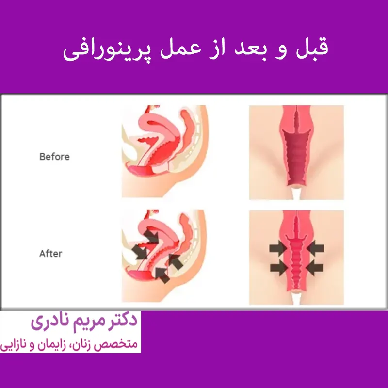 پرینورافی