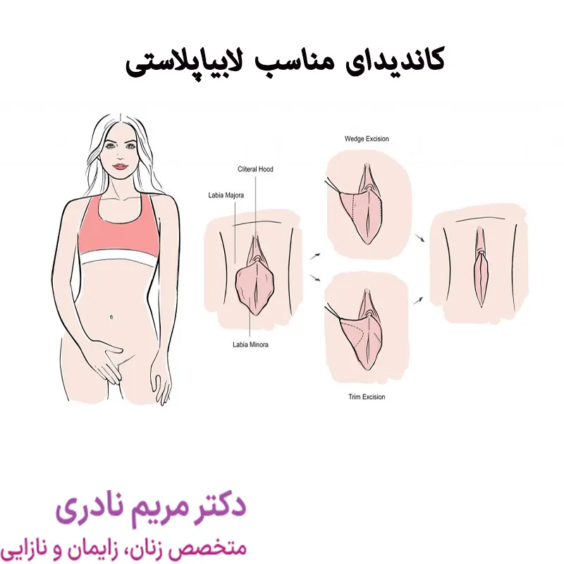 عکس و فیلم قبل و بعد از عمل لابیاپلاستی
