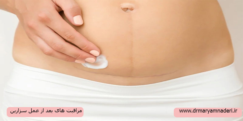 مراقبت-های-بعد-از-سزارین